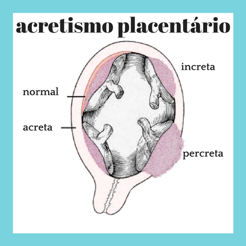 placenta-acreta-percreta-increta