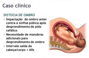 bebe-distocia-de-ombro-autor-melania-amorim-via slideplayer.com.br