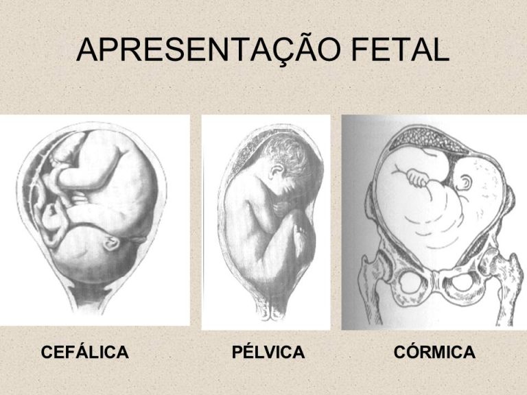 Apresentação Cefalica Com Dorso A Esquerda O Que Significa
