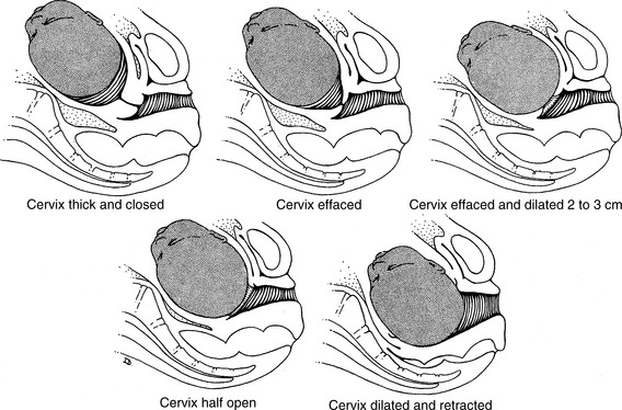 colo do útero e dilatação