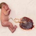 Benefícios do corte tardio do cordão umbilical em bebês recém-nascidos