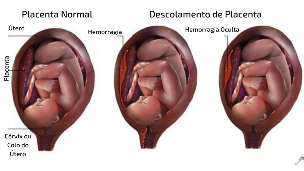 O Que é Descolamento De Placenta Casa Da Doula 