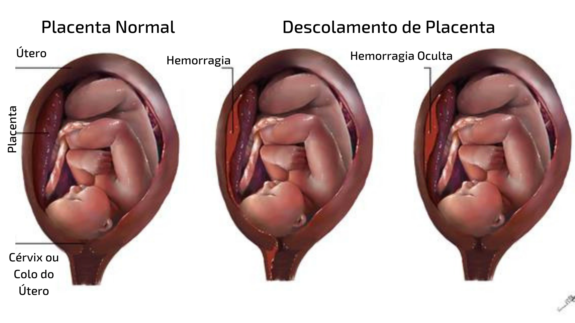 varicoza la placenta scazuta